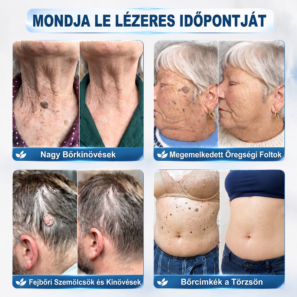 Hivatalos Márkabolt | 🚢🚢 Hiskin® 7 napos Szemölcseltávolító Roll-on Ápoló Folyadék (Fájdalommentes rollerball technológia, hegek nélkül) 🐬
